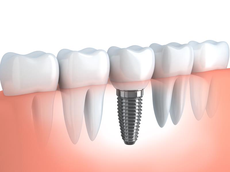 Dental Implants in Stoneham, MA