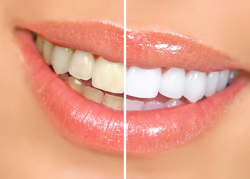 teeth whitening services in Stoneham, MA